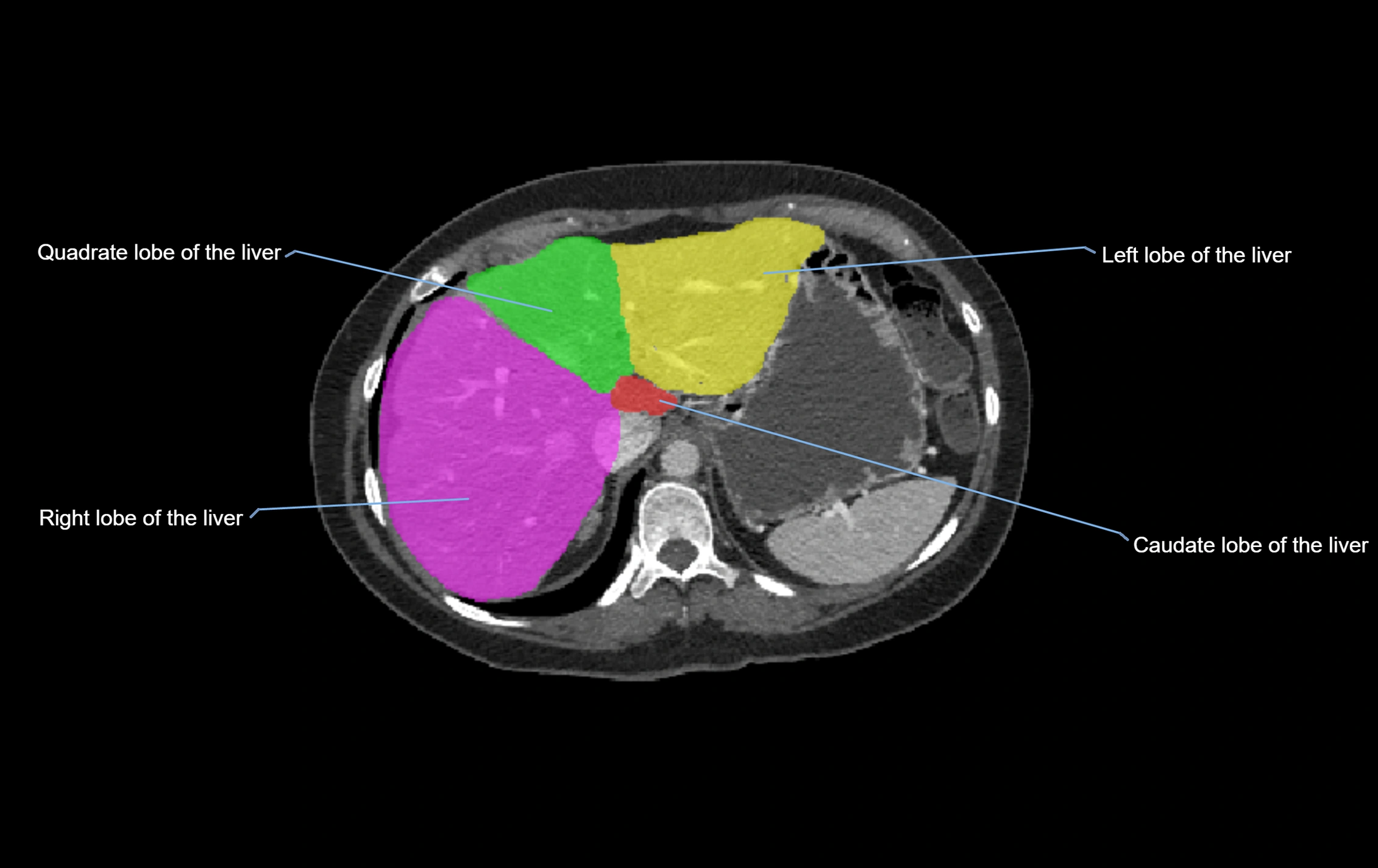 CT lliver lobes axial cross sectional anatomy labelled image -00056.webp